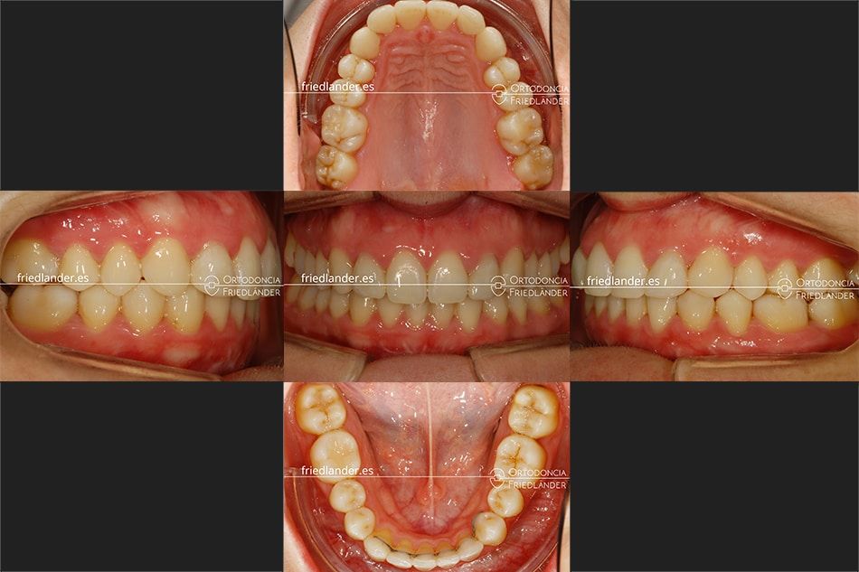 ortodoncia friedlander barcelona brackets esteticos canino inferior lingual