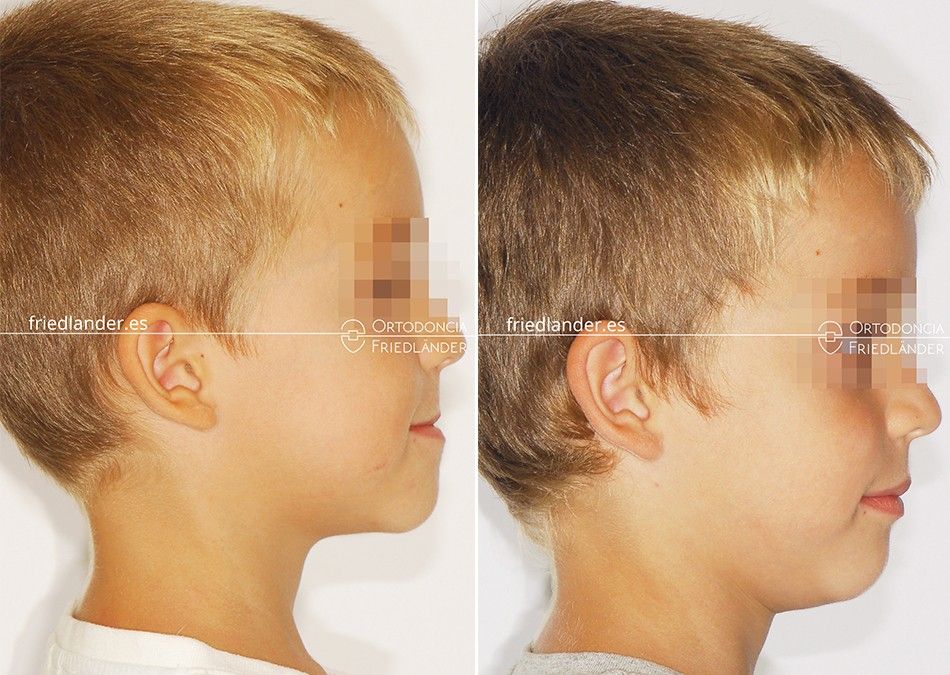 Ortodoncia Friedlander Barcelona clase-III disyuntor mascara facial cambios faciales