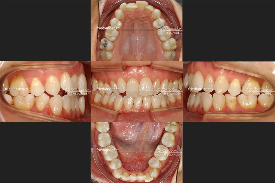 Ortodoncia Friedlander Barcelona invisalign transparente invisible antes tratamiento