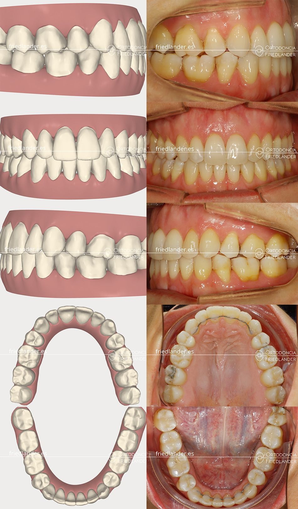 Ortodoncia Friedlander Barcelona invisalign transparente invisible clincheck