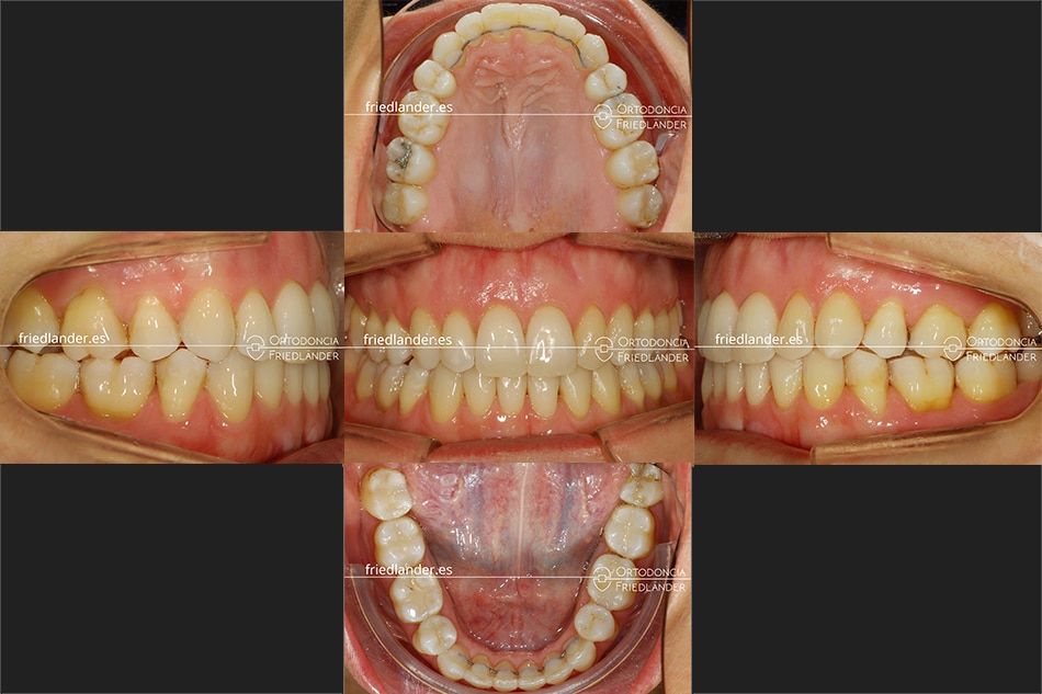 Ortodoncia Friedlander Barcelona invisalign transparente invisible despues tratamiento