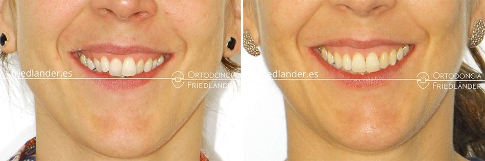 Ortodoncia Friedlander Barcelona invisalign transparente invisible sonrisa