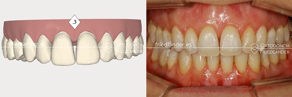 Ortodoncia Friedlander Barcelona invisalign transparente invisible stripping CC