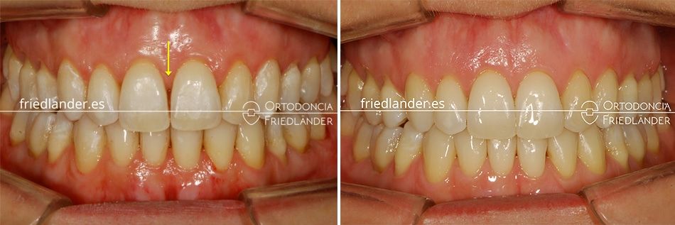 Ortodoncia Friedlander Barcelona invisalign transparente invisible stripping