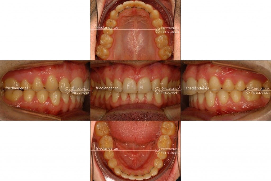 Ortodoncia Friedlander Barcelona tratamiento microtornillos clase II