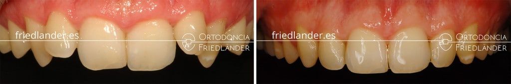 Ortodoncia Friedlander Barcelona tratamiento microtornillos clase II