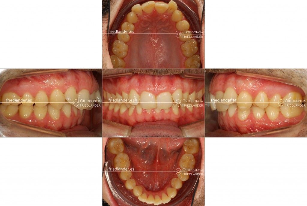 Ortodoncia Friedlander Barcelona tratamiento microtornillos clase II