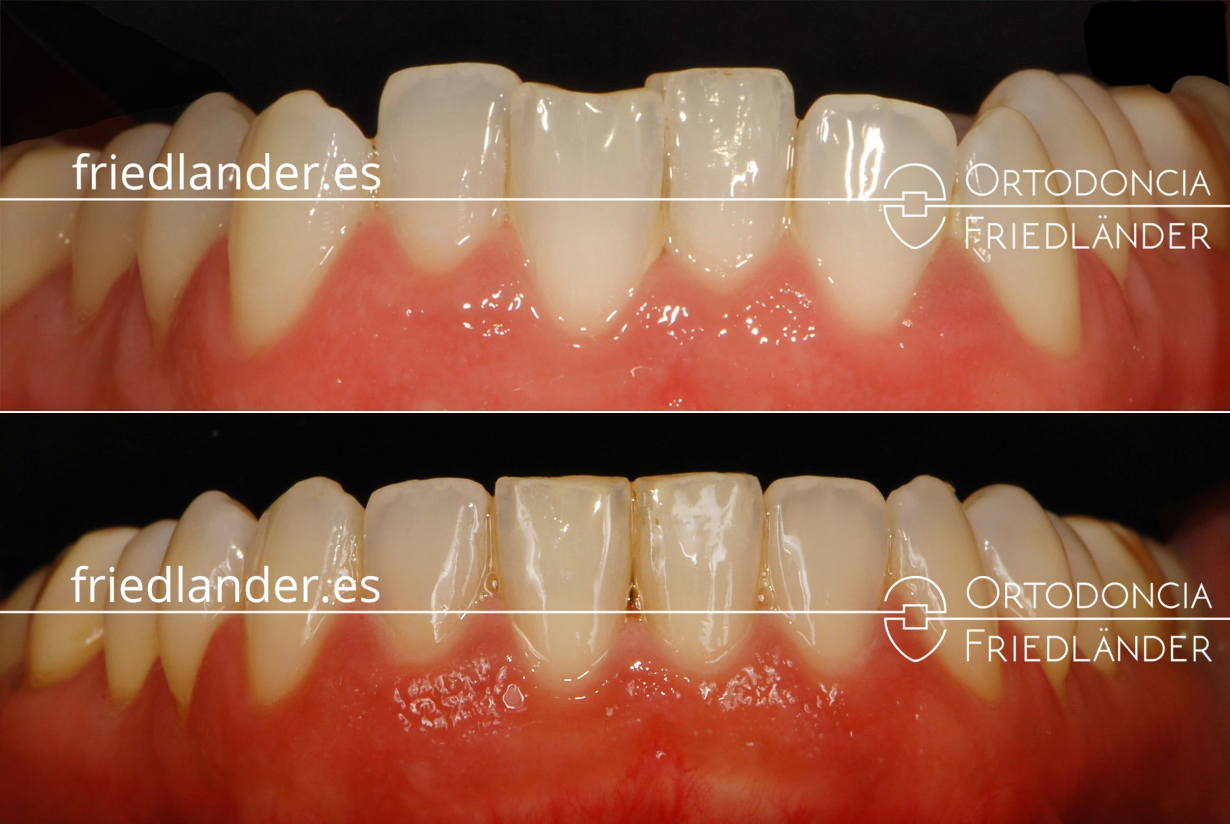 Ortodonia Friedlander Barcelona ortodoncia lingual invisible alineacion