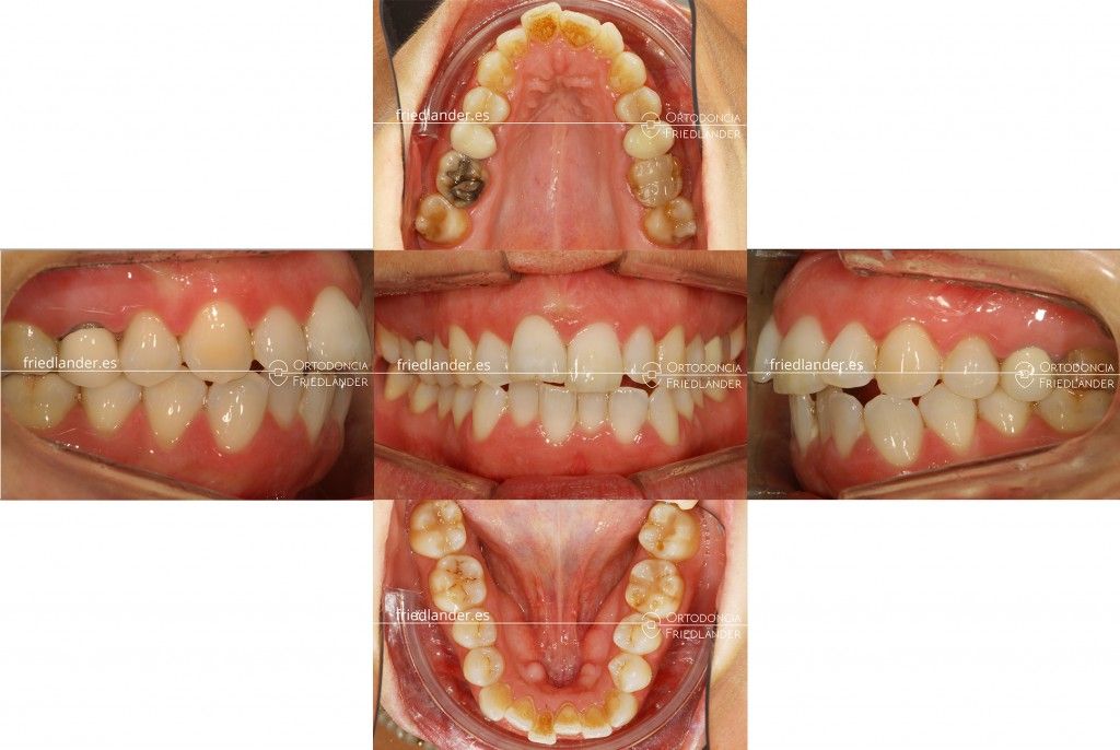 Ortodonia Friedlander Barcelona ortodoncia lingual invisible microtornillos
