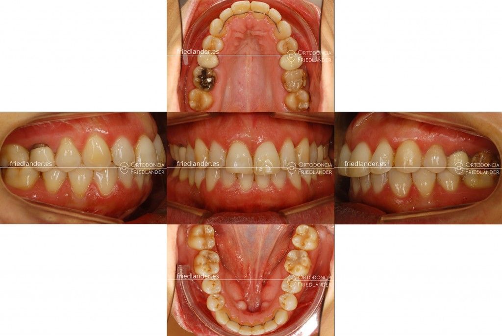 Ortodonia Friedlander Barcelona ortodoncia lingual invisible mordida abierta microtornillos
