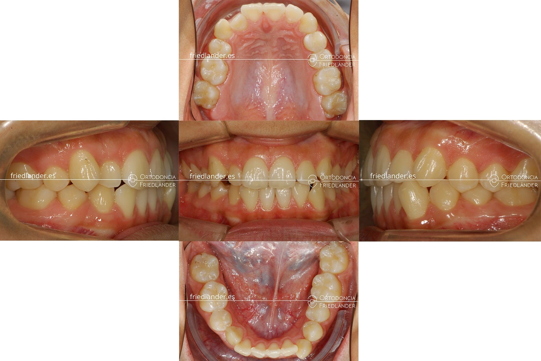 tratamiento de ortodoncia ortodoncia barcelona