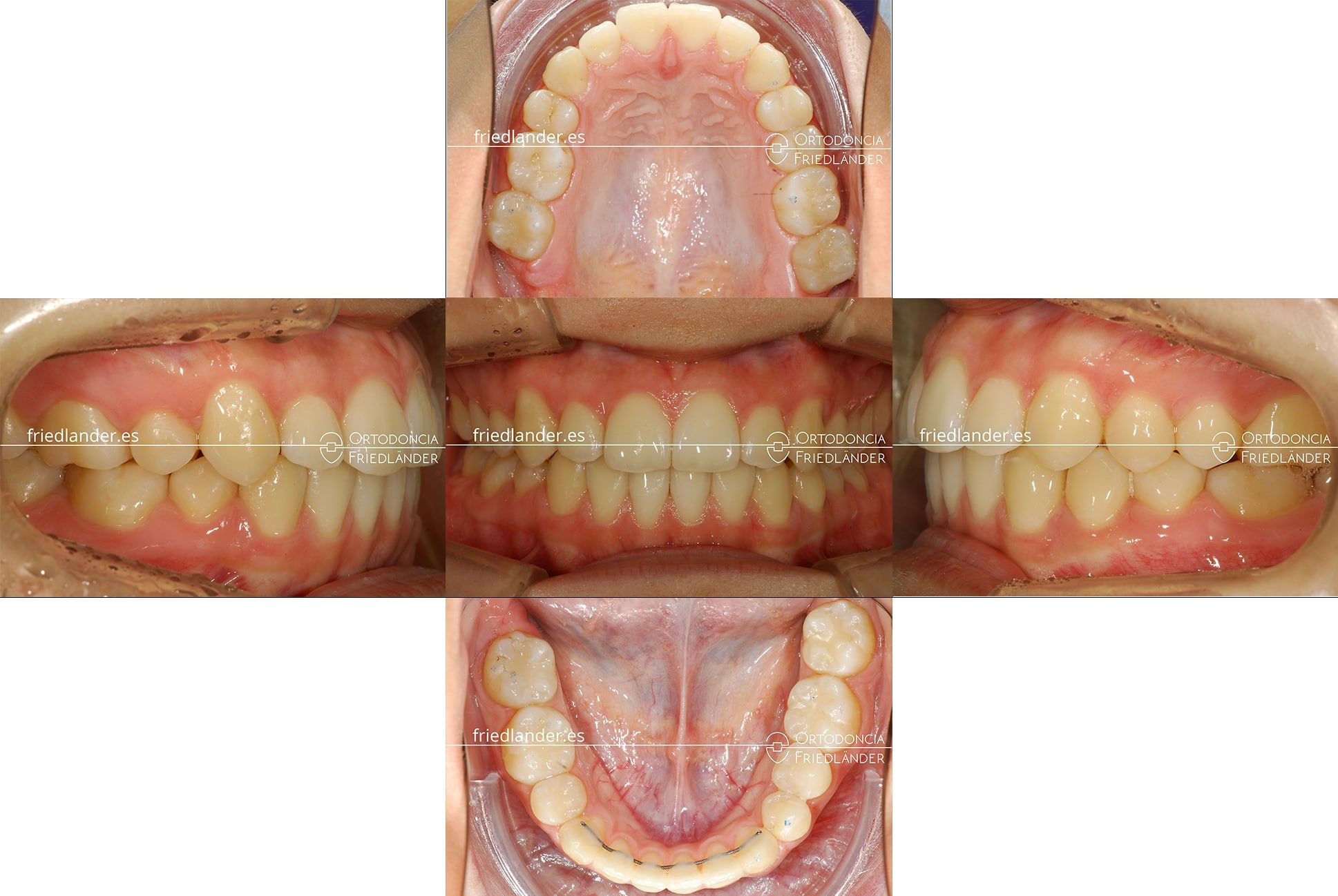 ortodoncia barcelona stripping
