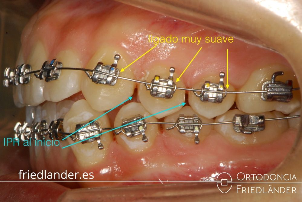 ortodoncia barcelona tratamiento