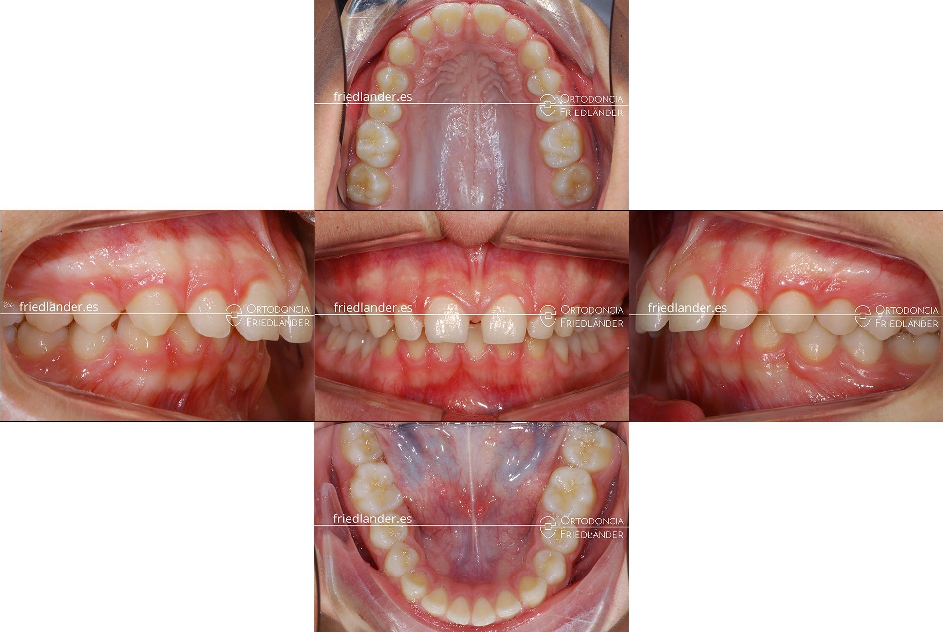 ortodoncia friedlander barcelona carillas laterales estetica antesv