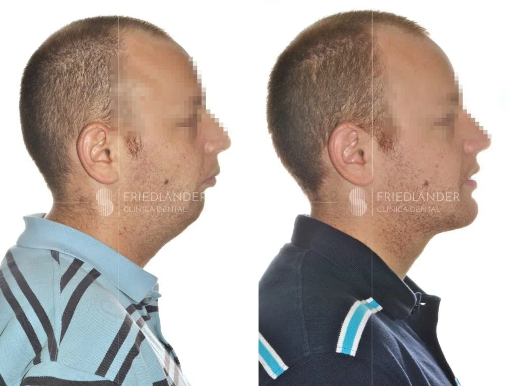 Cirugía ortognática para corregir deformidades faciales – Clínica Friedländer