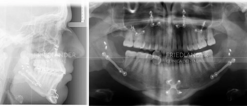 Planificación y resultado de una cirugía ortognática – Clínica Friedländer
