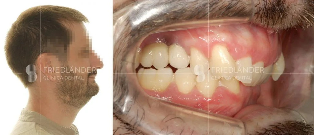 Paciente con clase II y cara corta tratado con cirugía ortognática – Clínica Friedländer