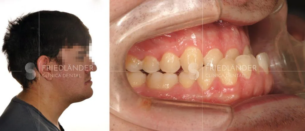Paciente con clase III y cara prognática tratado con cirugía ortognática – Clínica Friedländer