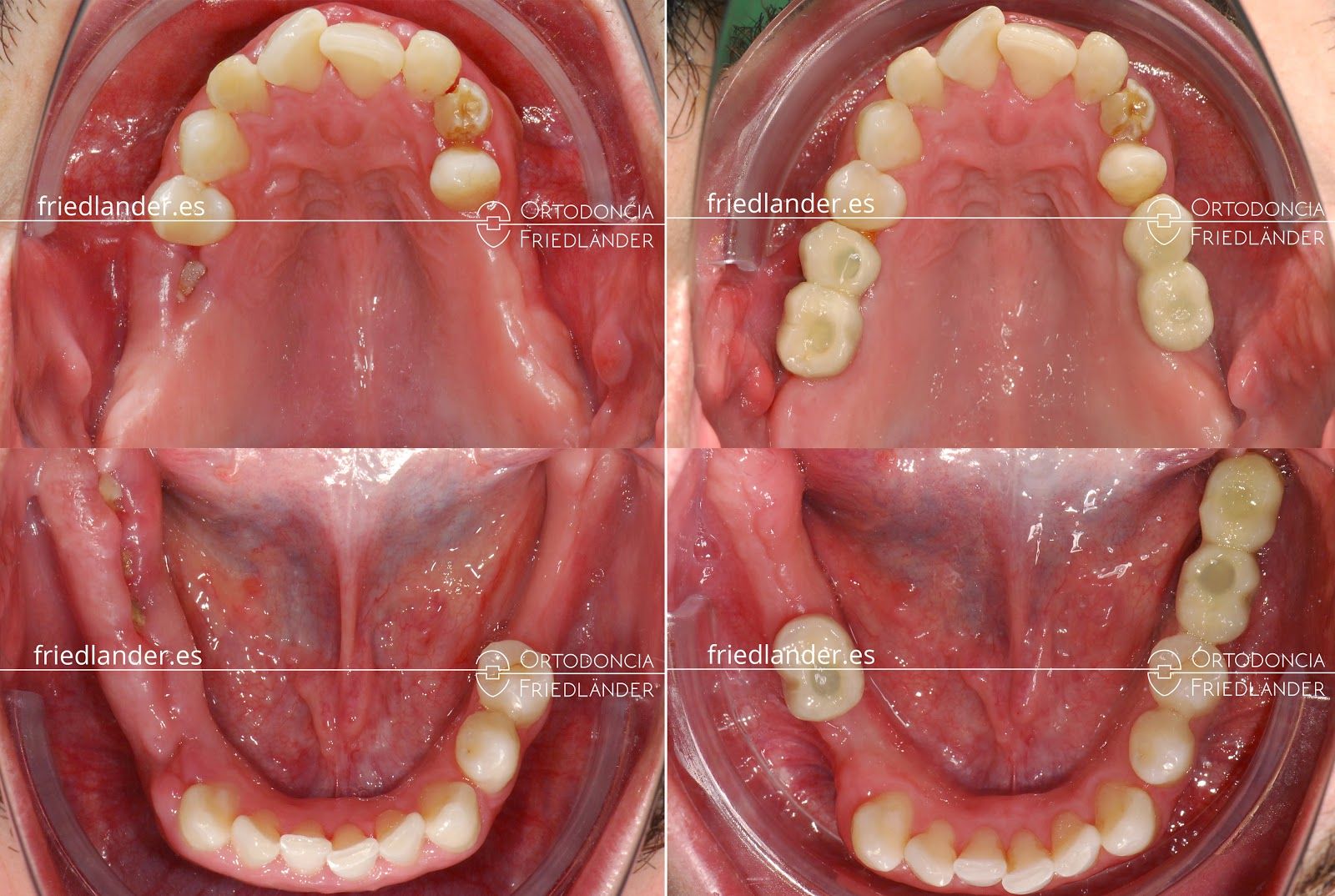 implante ortodoncia foto 2