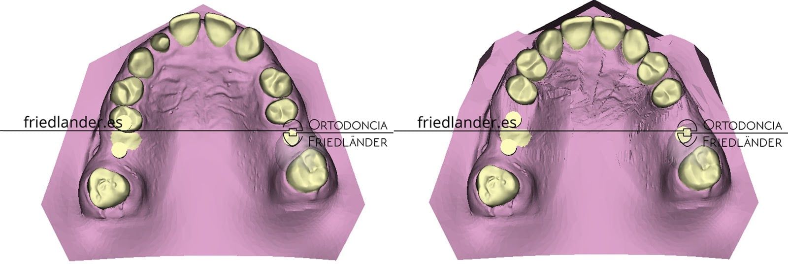 implantes ortodoncia