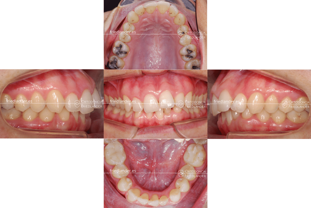 Ortodoncia Friedlander Barcelona agenesias implantes dentales caso complejo