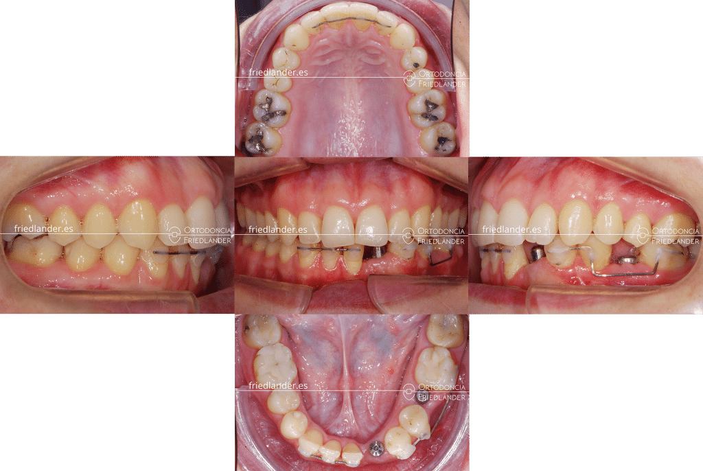 Ortodoncia Friedlander Barcelona agenesias implantes dentales caso complejo
