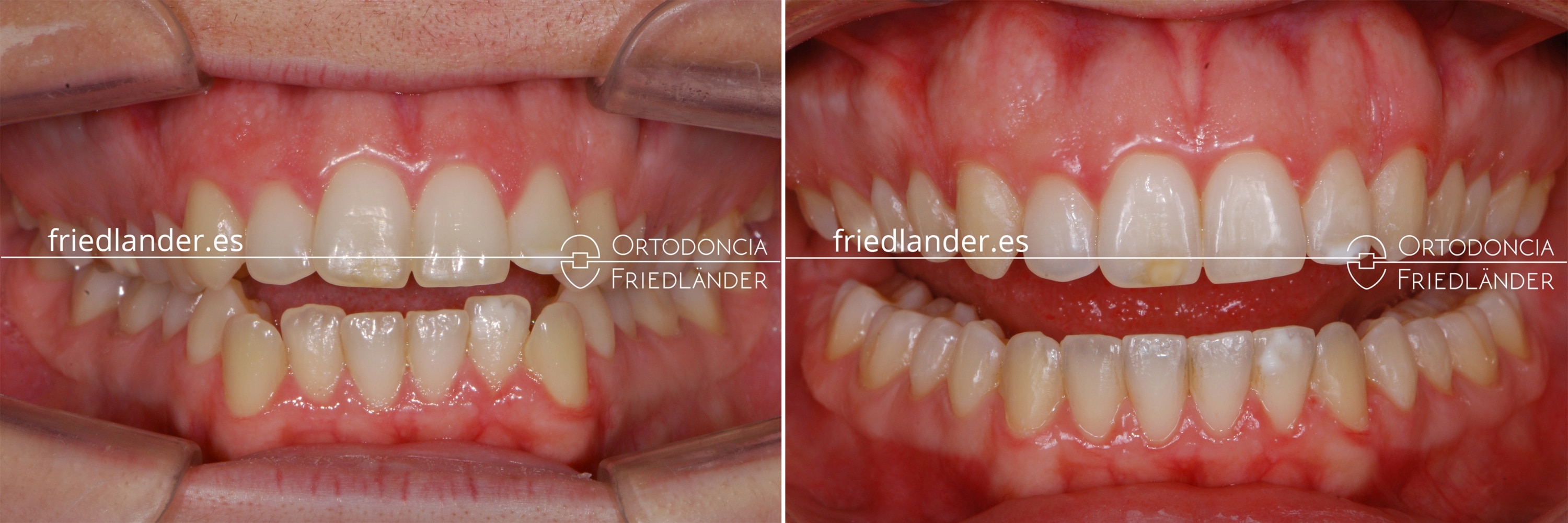 Ortodoncia Friedlander Barcelona tratamiento real invisalign transparente invisible mordida abierta