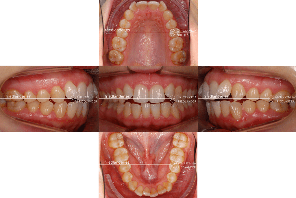 FRIEDLANDER ORTODONCIA BARCELONA CLINICA DENTAL CASOS COMPLEJO MORDIDA ABIERTA