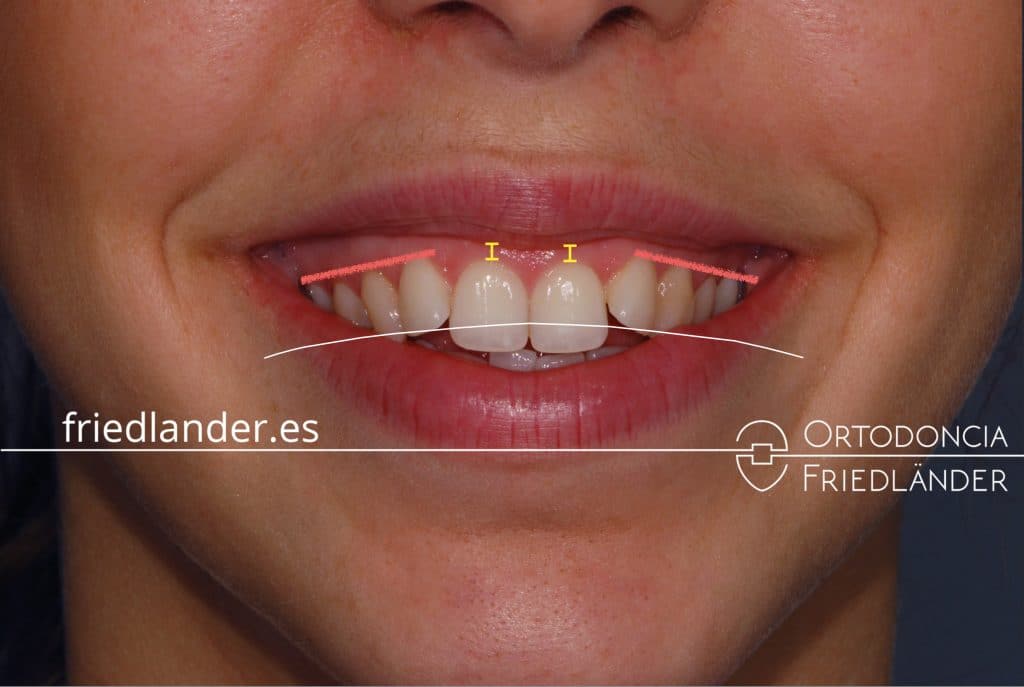 FRIEDLANDER ORTODONCIA BARCELONA CLINICA DENTAL CASOS COMPLEJO SONRISA ANALISIS