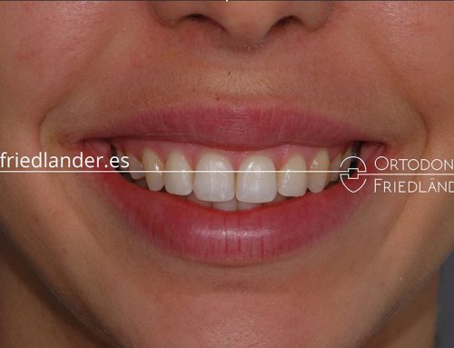 Tratamiento de mordida abierta y sonrisa gingival posterior con microtornillos y brackets estéticos – caso 47