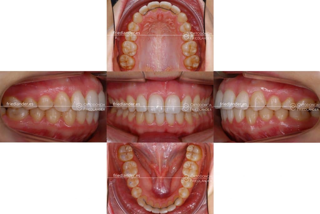 FRIEDLANDER ORTODONCIA BARCELONA CLINICA DENTAL COMPLEJO MORDIDA ABIERTA