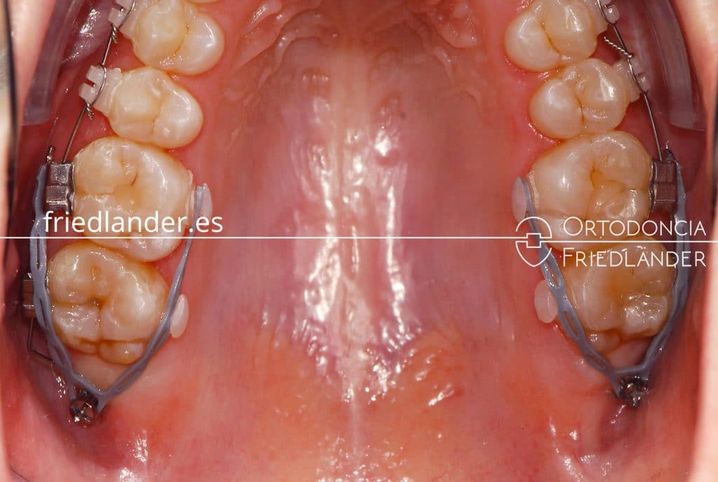 FRIEDLANDER ORTODONCIA BARCELONA CLINICA DENTAL MICROTORNILLOS CASOS COMPLEJO MORDIDA ABIERTA