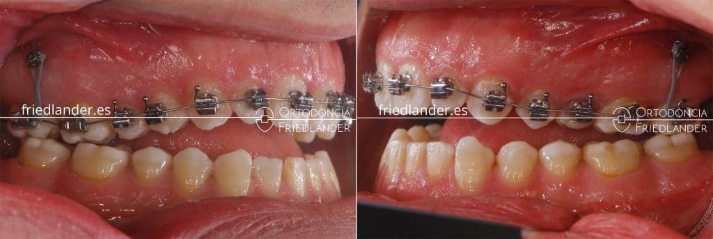 Ortodoncia Friedlander barcelona mordida abierta microtornillos