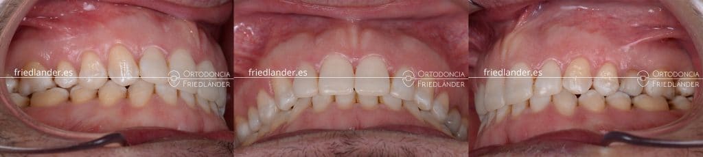 Ortodoncia Friedlander barcelona mordida abierta microtornillos