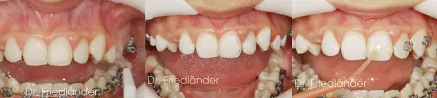 Aplicación del adhesivo especial para brackets