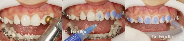 Grabado ácido de los dientes antes de colocar los brackets