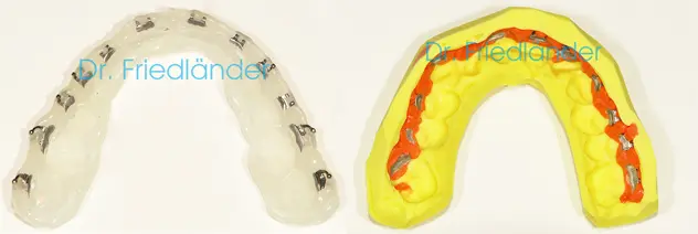 Férula de transferencia de silicona con los brackets