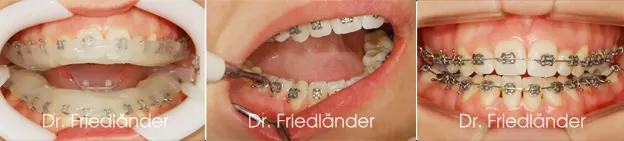 Brackets transferidos y fijados en los dientes del paciente