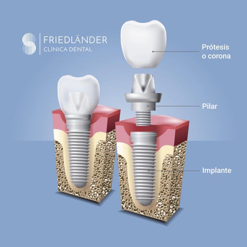 Cuantos Implantes Se Necesitan Para Una Dentadura Completa ¿Qué es un implante dental y cuánto cuesta?