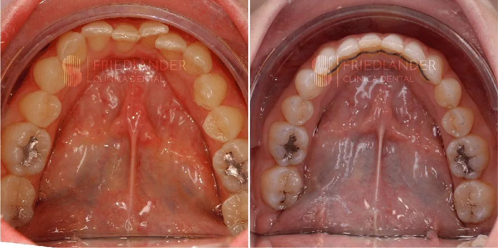 Retenedor fijo colocado en la cara interna de los dientes