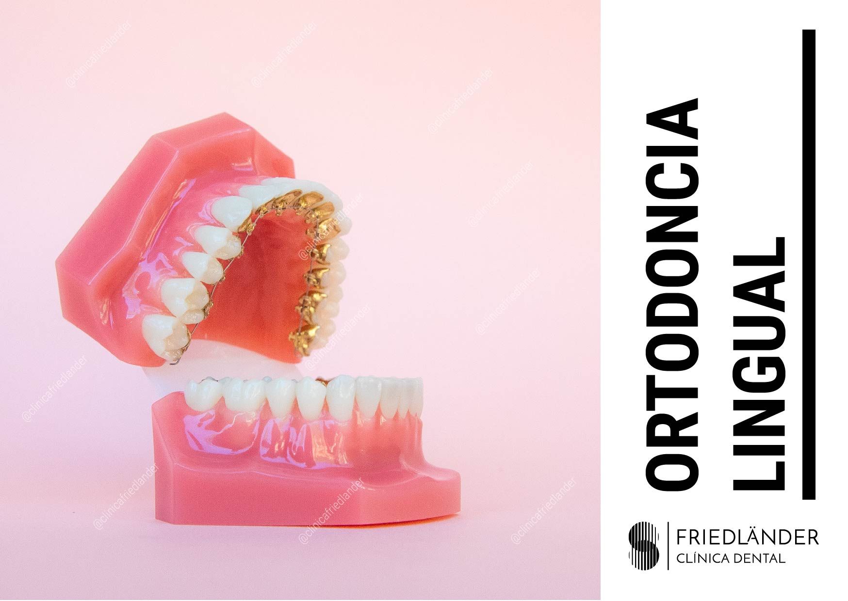 ortodoncia lingual friedlander