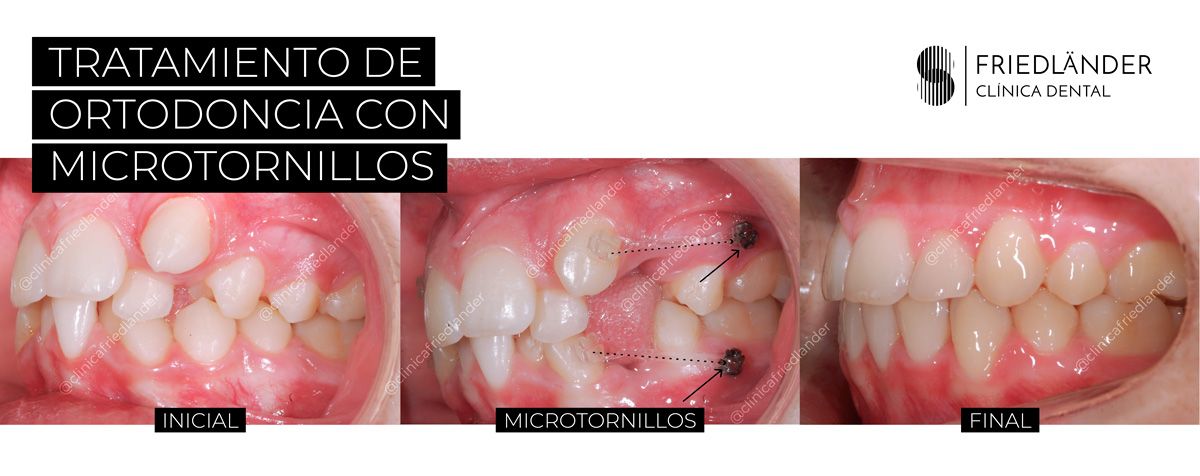 tratamientos de ortodoncia con microtornillos