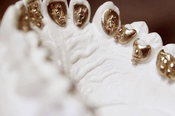 posicionamiento de brackets linguales