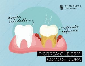 Piorrea que es y como se cura