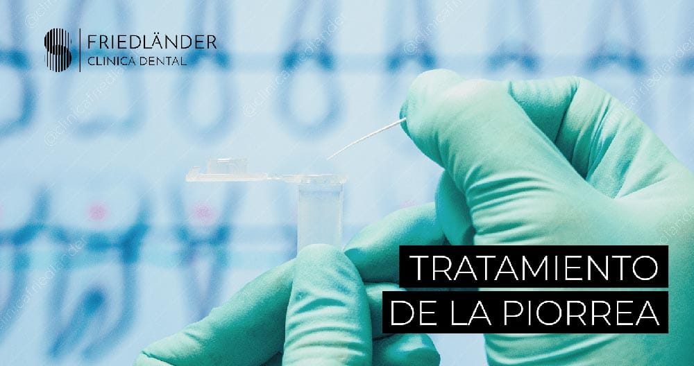 Tratamiento-piorrea como se cura la piorrea