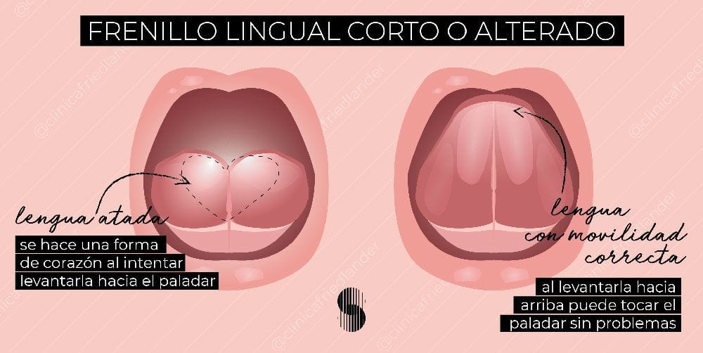 Frenillo Lingual corto o alterado frenillo lingual alterado clinica friedlander