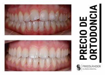 precio de ortodoncia