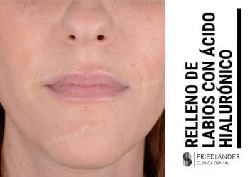 relleno de ácido hialurónico para labios