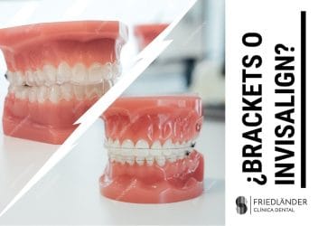 invisalign es mejor que los brackets