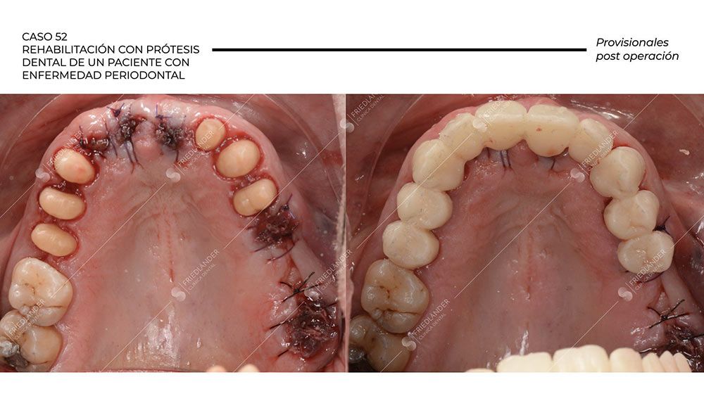 protesis periodontitis
